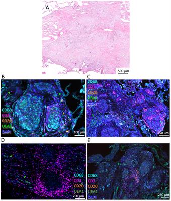 Immune mapping of human tuberculosis and sarcoidosis lung granulomas
